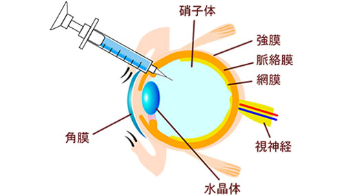 硝子体内注射のイメージ